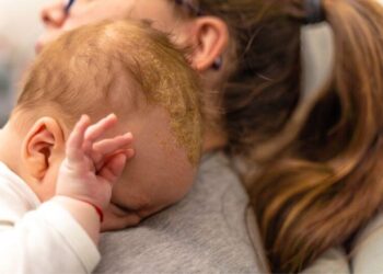 Seboreik Dermatit Nedir?