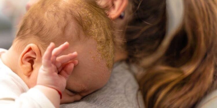 Seboreik Dermatit Nedir?